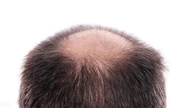 脱发的几种类型和原因是什么？如何预防脱发？