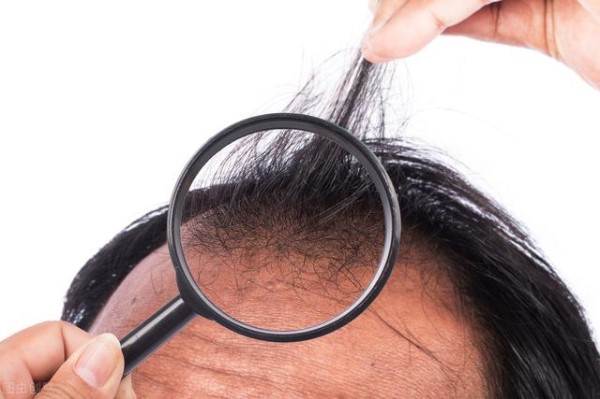 雄激素性脱发是什么原因引起的