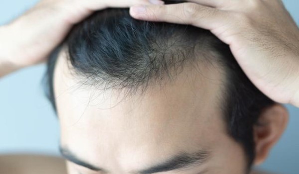 脱发的几种类型和原因是什么？饮食调理可预防脱发！