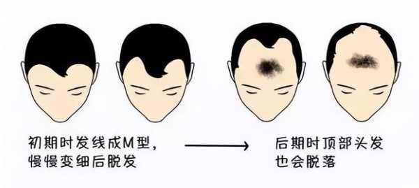 什么是雄性激素脱发？雄激素性脱发有什么症状？