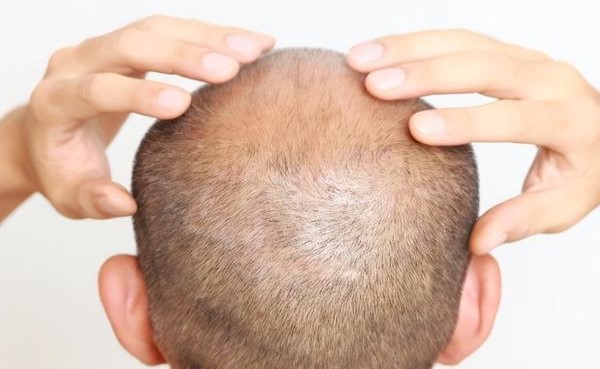 掉发很严重是什么原因造成的？吃什么有助于防脱发生发？