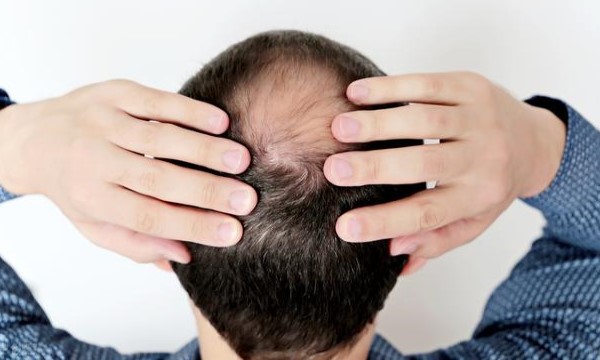 脂溢性脱发中医怎么调理？