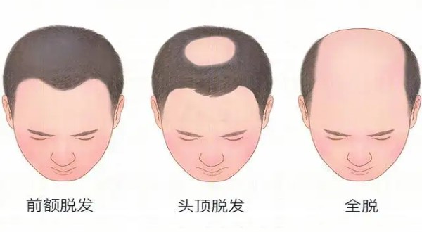 植发后如何预防脱发