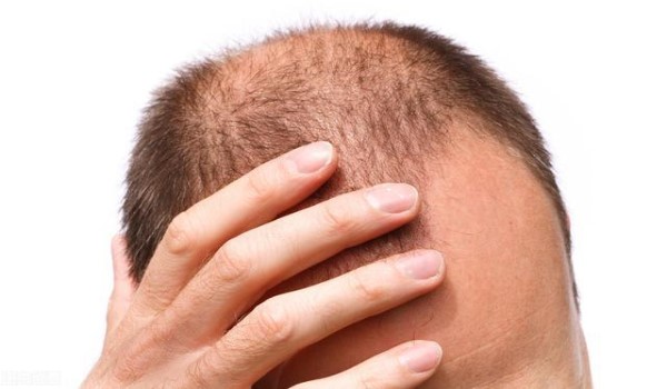 防止脱发秃顶怎么办？