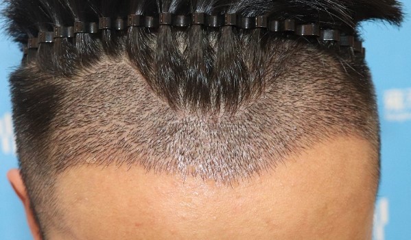 脂溢性脱发头皮上有白色颗粒怎么办？原因与治疗方法详解