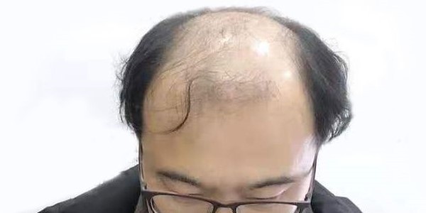 植眉毛一般要多少钱安心华肤植发