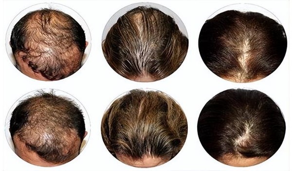 30岁女人如何防脱生发呢图片