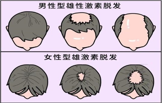 30岁男性发际线延伸脱发秃顶的应对方法
