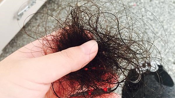 脱发严重是什么原因引起的怎么治脱发