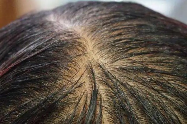 熬夜过多会导致男性秃顶？如何预防和应对这一问题？