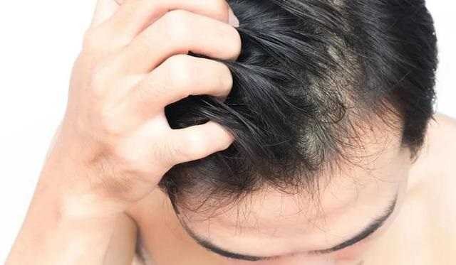 男生脂溢性脱发是什么原因引起的怎么办