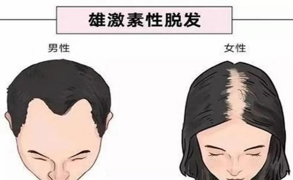 脂溢性脱发头发有臭味怎么办？