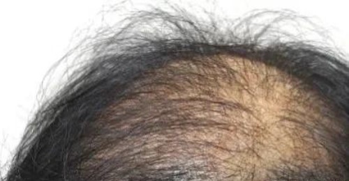 初中生如何生发和防止脱发