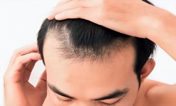 35岁男士如何防止脱发