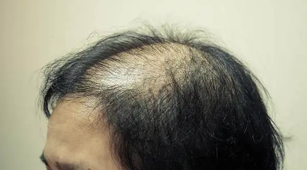 30岁男性发际线延伸脱发秃顶问题解决方法