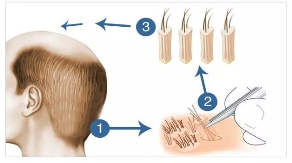 烫发引起的脱发秃顶：如何预防和处理？