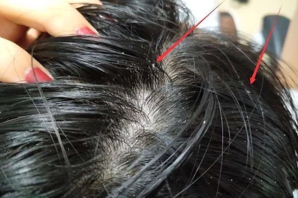 如何抑制雄性激素防止脱发呢女性