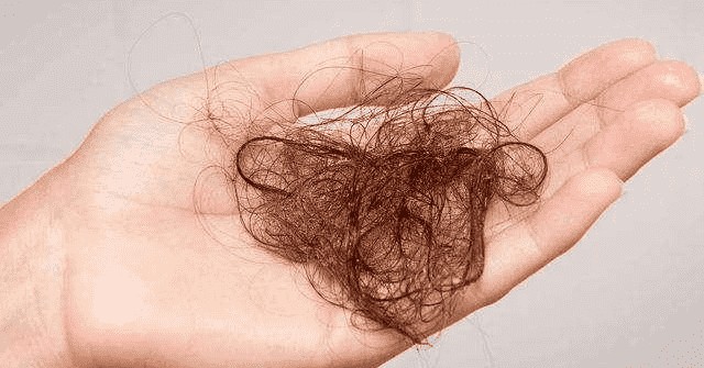 脱发严重是什么原因引起的脂溢性脱发怎么办