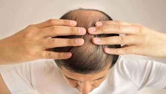 如何抑制雄性激素防止脱发