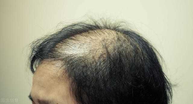 怎么防止肾虚型脱发，让头发健康生长