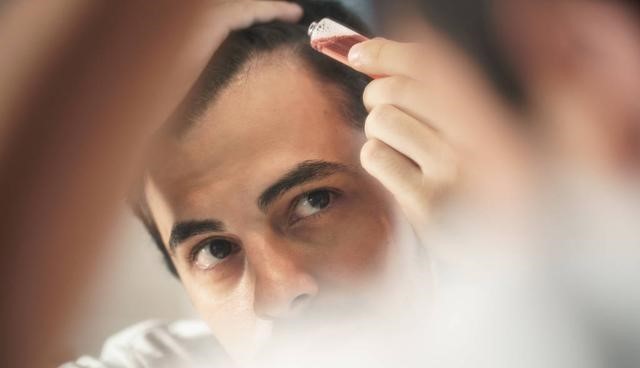 脂溢性脱发：预防和治疗的综合指南