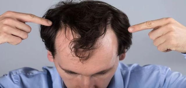 少量脱发是什么原因引起的？