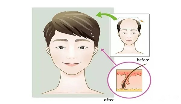 熬夜如何做防止脱发和脱发的检查