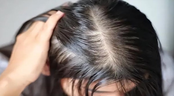 脂溢性脱发夏天严重怎么办呢