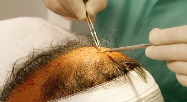 头皮头癣和脱发的原因分析及预防方法