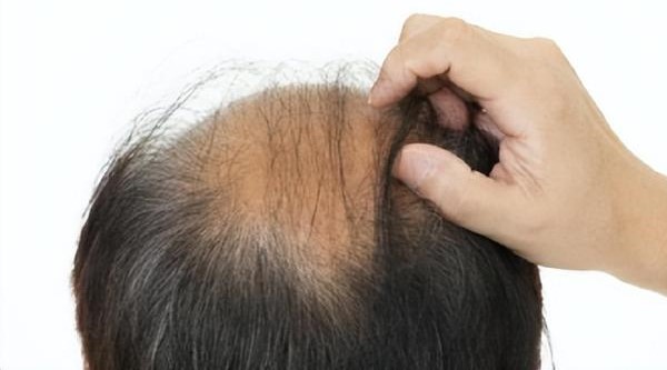 熬夜掉头发严重秃顶怎么办？有效对策保护发质！