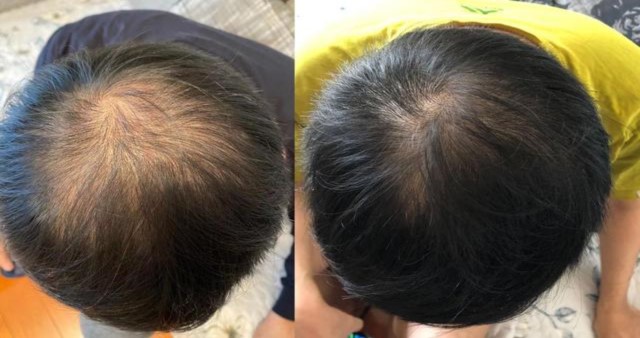40岁男人如何防脱发及生发方法