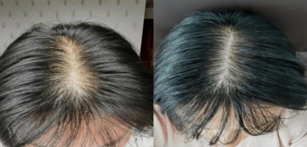 脂溢性脱发后长出头发的应对方法和护理指南