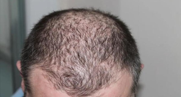 女性晚期脂溢性脱发还能长发吗怎么办