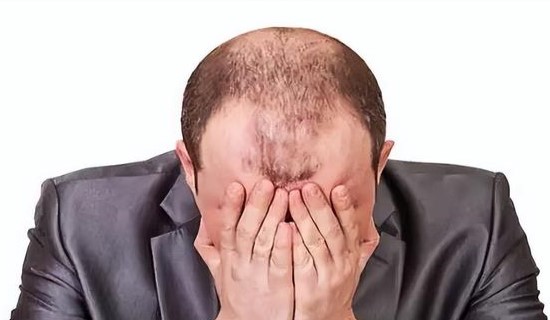 如何有效应对脂溢性脱发和白发问题