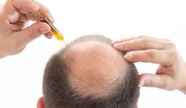 深圳脂溢性脱发的症状、原因和治疗方法