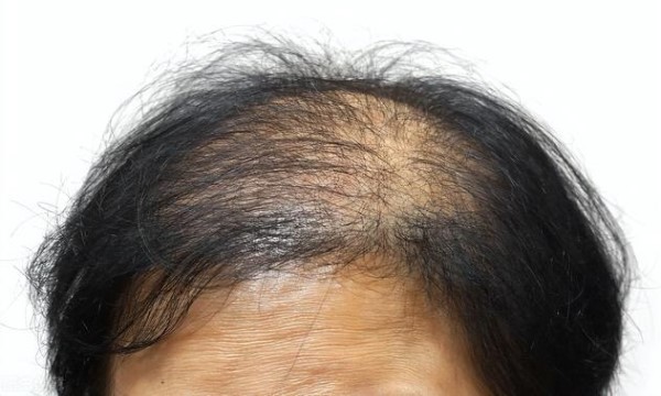 放疗脱发是什么原因引起的