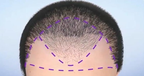 脂溢性脱发的治疗方法和预防措施