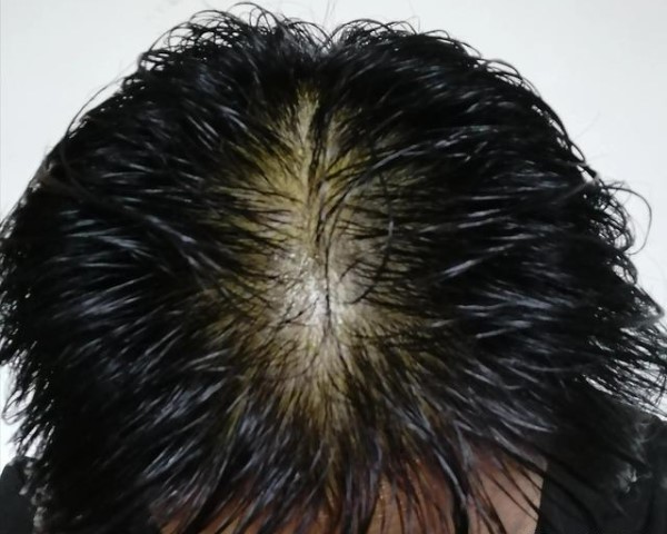 头发长期没吹干导致脂溢性脱发怎么办