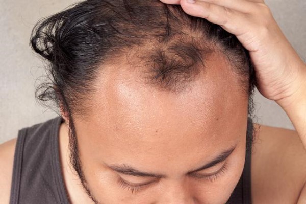 40岁脂溢性脱发怎么办——解决脱发问题的有效方法