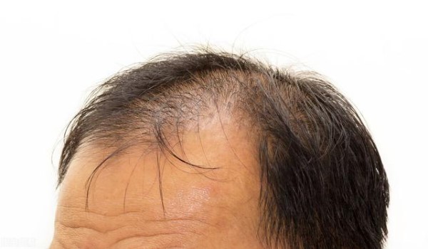脂溢性脱发秃顶的防治方法