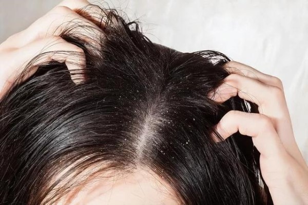 脂溢性脱发毛囊破坏的原因和治疗方法