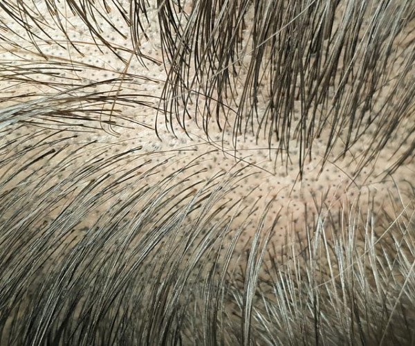 30岁脱发秃顶怎么办？有效的解决方案和护发建议