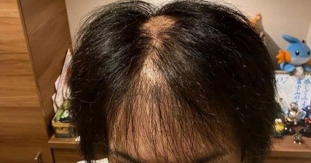 脱发严重是什么原因引起的脂溢性脱发