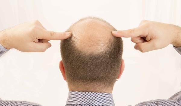 秃顶问题解决方案：两侧秃顶怎么办？