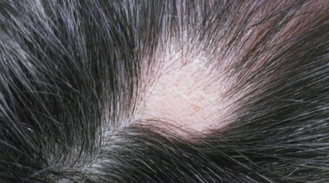 如何有效防止雄激素脱发