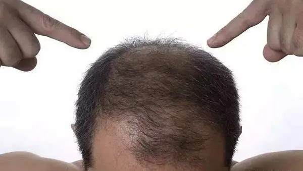 经期脱发是什么原因引起的？