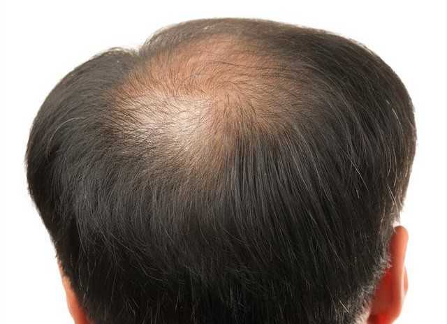 脱发原因及治疗如何防止脱发的方法有哪些