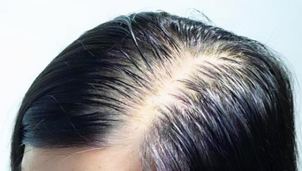 光头植发一般要多少钱？解析光头植发的费用和效果